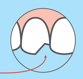 Chipped tooth graphic