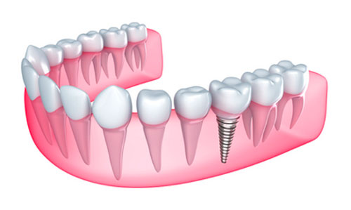 I Can't Afford An Implant Right Now, What Are My Options?