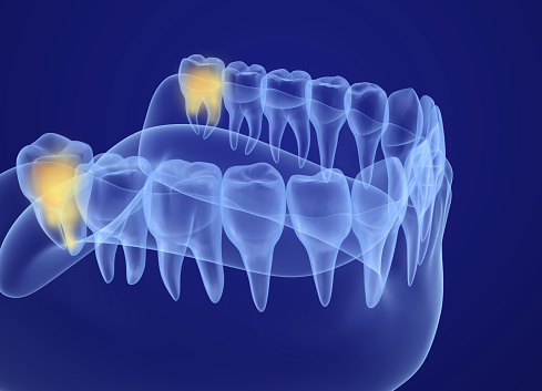diagram of wisdom teeth 