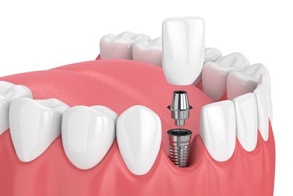 dental implant graphic
