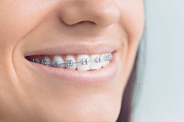 Close up of smiling woman with metal braces at East Village Dental Centre.