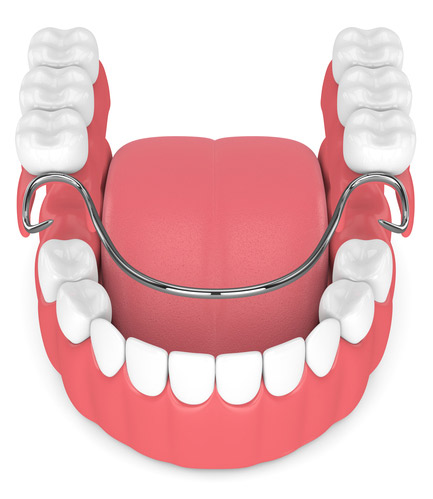 partial denture graphic